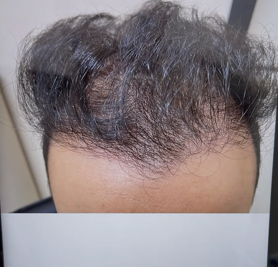 قبل العلاج — حالة رجالية