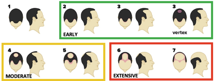 Norwood-Hamilton scale diagram showing the 7 stages of male androgenetic alopecia, color-coded as Early, Moderate, and Extensive