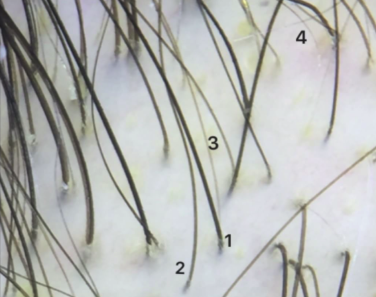 Trichoscopy close-up showing hair shaft diameter diversity in male androgenetic alopecia